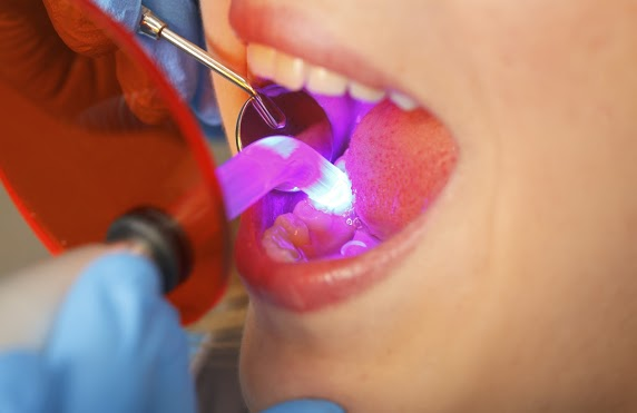 How Do Dentists Do Fillings?